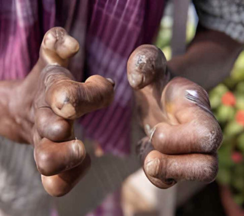 World Leprosy Day 2026